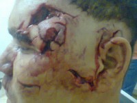 Homem fica irreconhecível após tetativa de homicídio em Parelhas